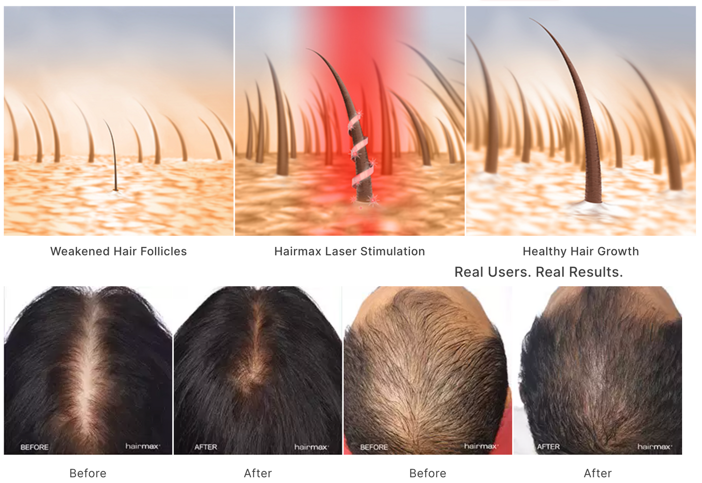 Hair Growth Booster Kit - Red light Therapy Cap