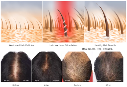 Hair Growth Booster Kit - Red light Therapy Cap